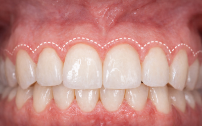 Tout savoir sur la greffe de gencive au collagène : solutions modernes pour la récession gingivale