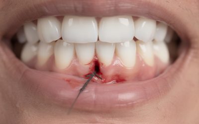 Que faire lorsque le fil de suture lâche après une extraction de dent de sagesse ?